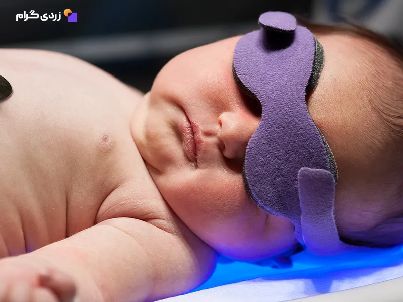 نوزاد داخل دستگاه فتوتراپی با چشم بند